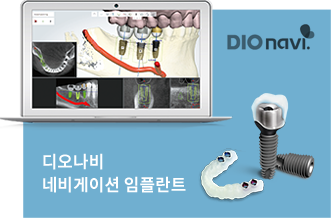 디오나비 네비게이션 임플란트