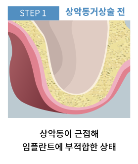 동두천임플란트 상악동거상술 전