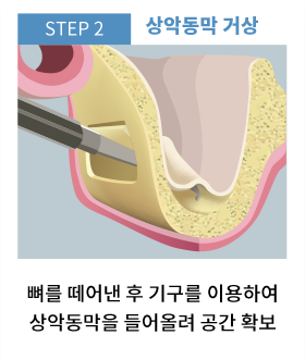 동두천임플란트 상악동막 거상