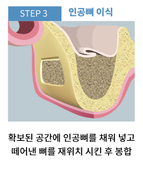 동두천임플란트 인공뼈 이식