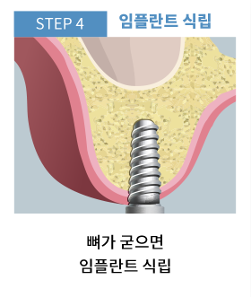 동두천임플란트 임플란트 식립